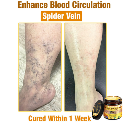 𝐋𝐎𝐕𝐈𝐋𝐃𝐒™ 𝐁𝐞𝐞 𝐕𝐞𝐧𝐨𝐦 𝐀𝐥𝐥-𝐢𝐧-𝐎𝐧𝐞 𝐂𝐫𝐞𝐚𝐦–🌸 Anti-aging,Hydrating, Skin Repair, Even Tone, Acne and Dark Spot Treatment, Wart and Mole Removal, Psoriasis Relief