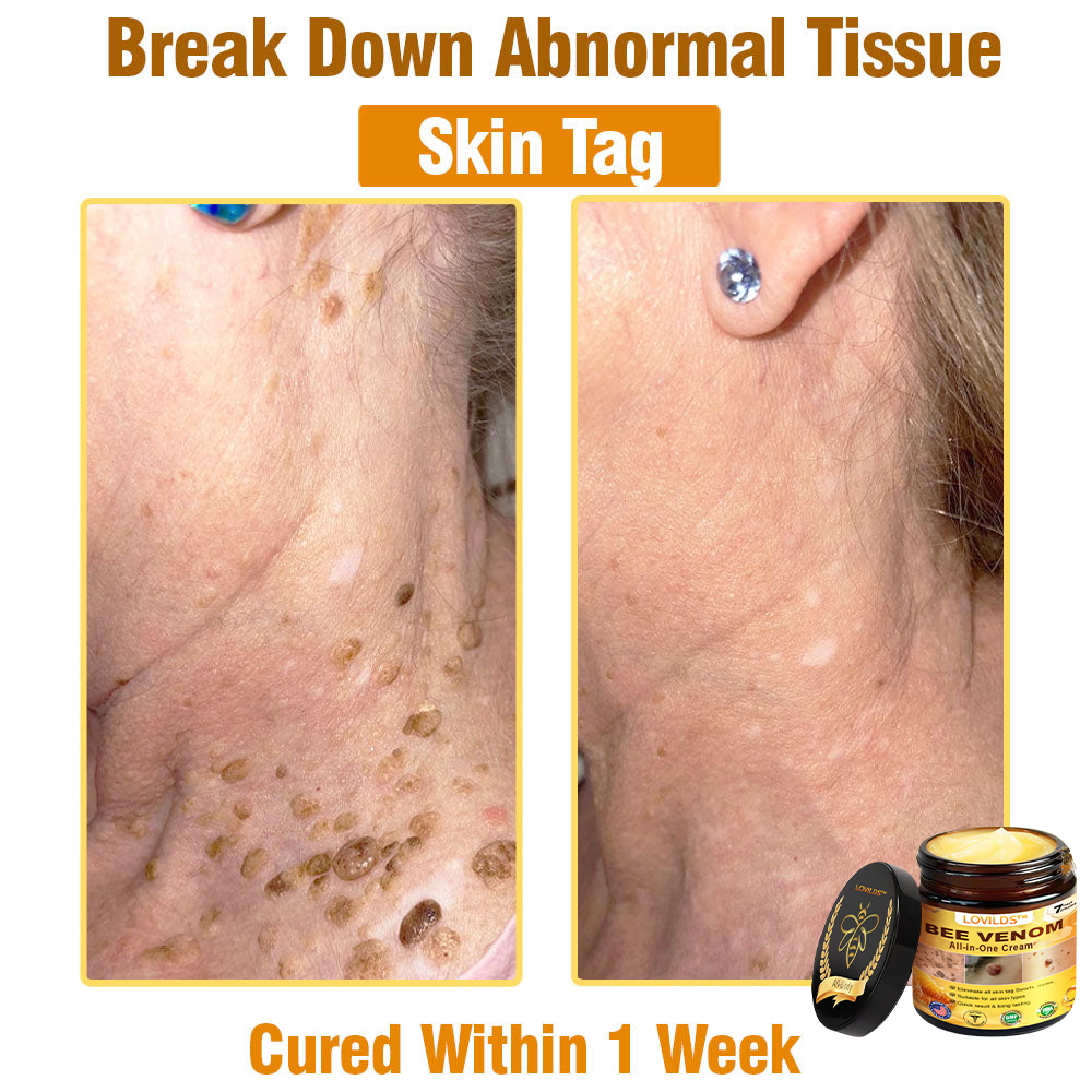 𝐋𝐎𝐕𝐈𝐋𝐃𝐒™ 𝐁𝐞𝐞 𝐕𝐞𝐧𝐨𝐦 𝐀𝐥𝐥-𝐢𝐧-𝐎𝐧𝐞 𝐂𝐫𝐞𝐚𝐦–🌸 Anti-aging,Hydrating, Skin Repair, Even Tone, Acne and Dark Spot Treatment, Wart and Mole Removal, Psoriasis Relief
