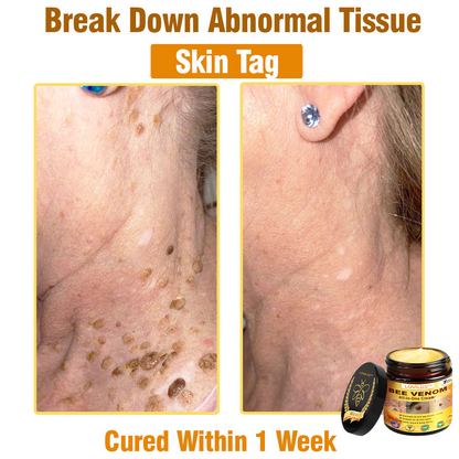 𝐋𝐎𝐕𝐈𝐋𝐃𝐒™ 𝐁𝐞𝐞 𝐕𝐞𝐧𝐨𝐦 𝐀𝐥𝐥-𝐢𝐧-𝐎𝐧𝐞 𝐂𝐫𝐞𝐚𝐦–🌸 Anti-aging,Hydrating, Skin Repair, Even Tone, Acne and Dark Spot Treatment, Wart and Mole Removal, Psoriasis Relief