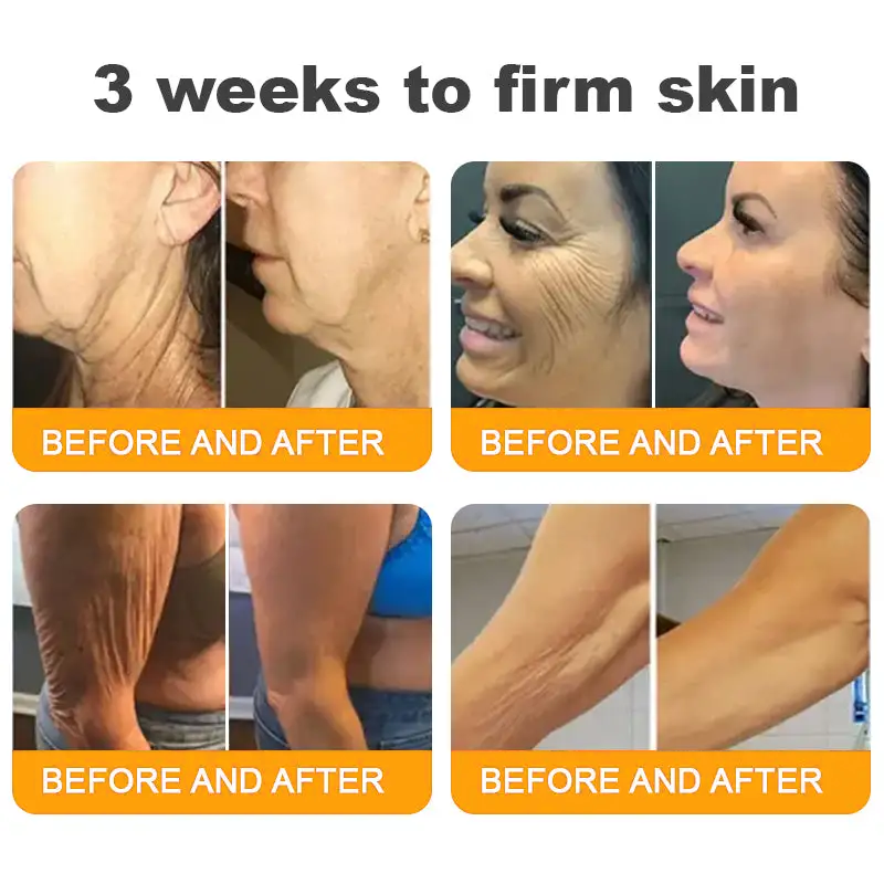 𝐋𝐎𝐕𝐈𝐋𝐃𝐒™ 𝐁𝐞𝐞 𝐕𝐞𝐧𝐨𝐦 𝐀𝐥𝐥-𝐢𝐧-𝐎𝐧𝐞 𝐂𝐫𝐞𝐚𝐦–🌸 Anti-aging,Hydrating, Skin Repair, Even Tone, Acne and Dark Spot Treatment, Wart and Mole Removal, Psoriasis Relief